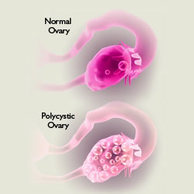 Πολυκυστική μορφολογία ωοθήκης